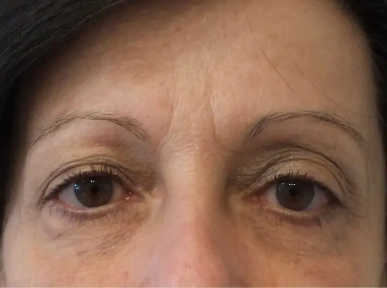 BOTOX® Cosmetic - Case 232 - Before