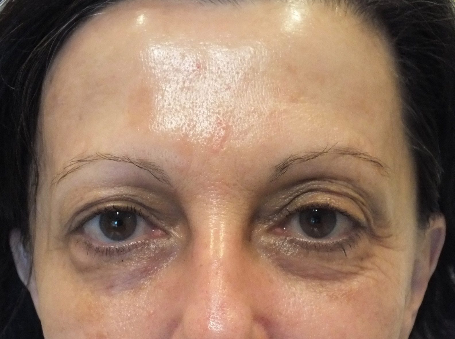 BOTOX® Cosmetic Patient Photo - Case 232 - after view-0