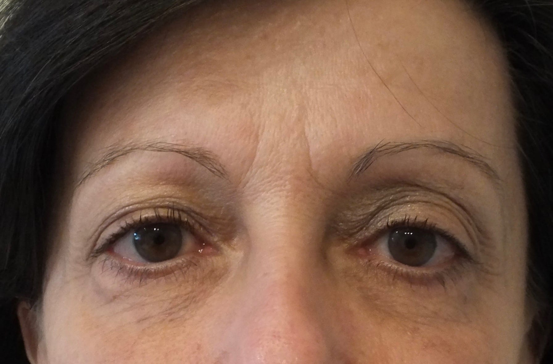 BOTOX® Cosmetic Patient Photo - Case 232 - before view-