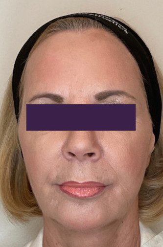 Facial Fillers - Case 3968 - After
