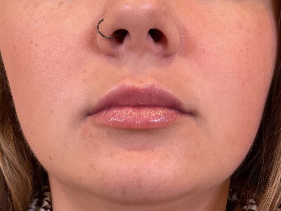 Facial Fillers - Case 4018 - After