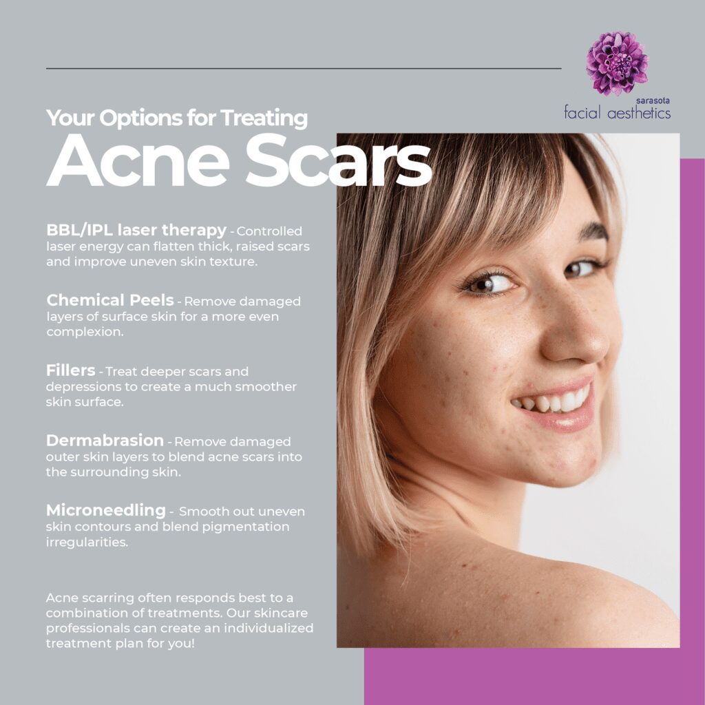 Your Options for Treating Acne Scars