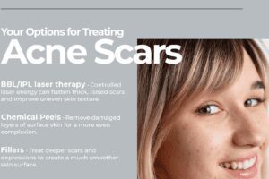 Your Options for Treating Acne Scars thumb