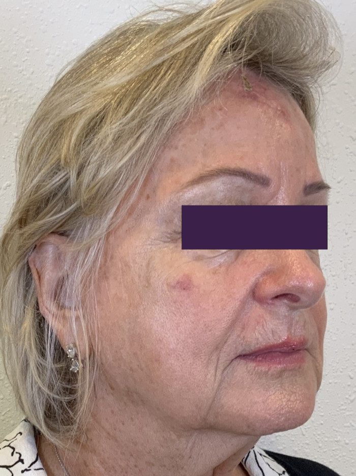 Facial Fillers Patient Photo - Case 4053 - before view-1