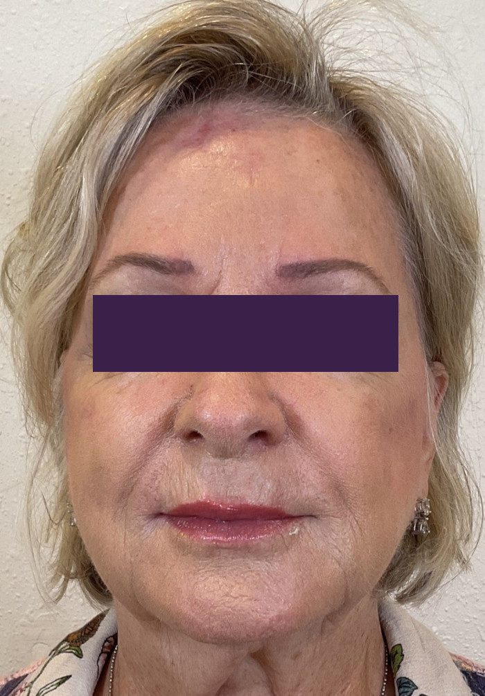 Facial Fillers - Case 4053 - After