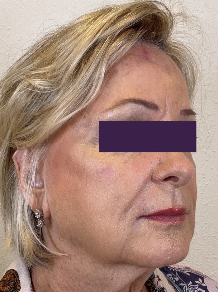 Facial Fillers Patient Photo - Case 4053 - after view-1