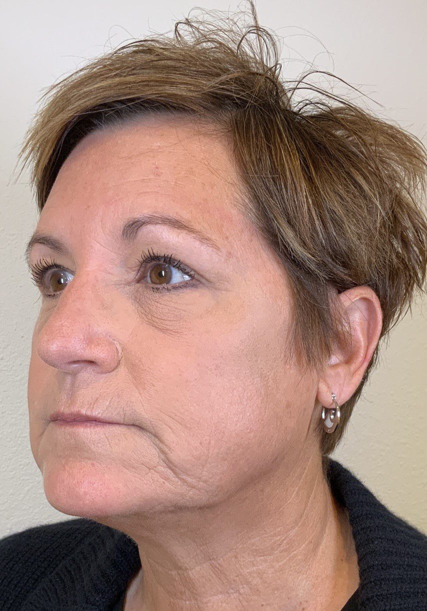 Facial Fillers Patient Photo - Case 4062 - before view-2