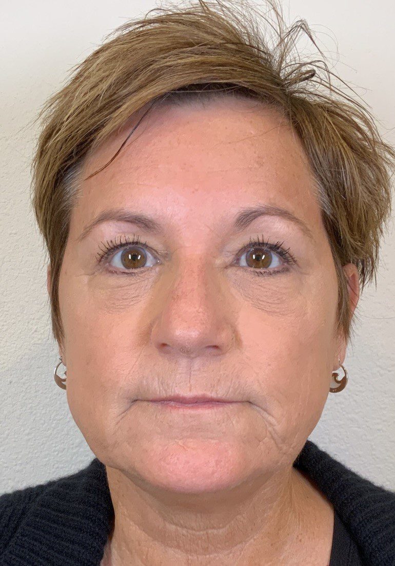 Facial Fillers Patient Photo - Case 4062 - before view-0