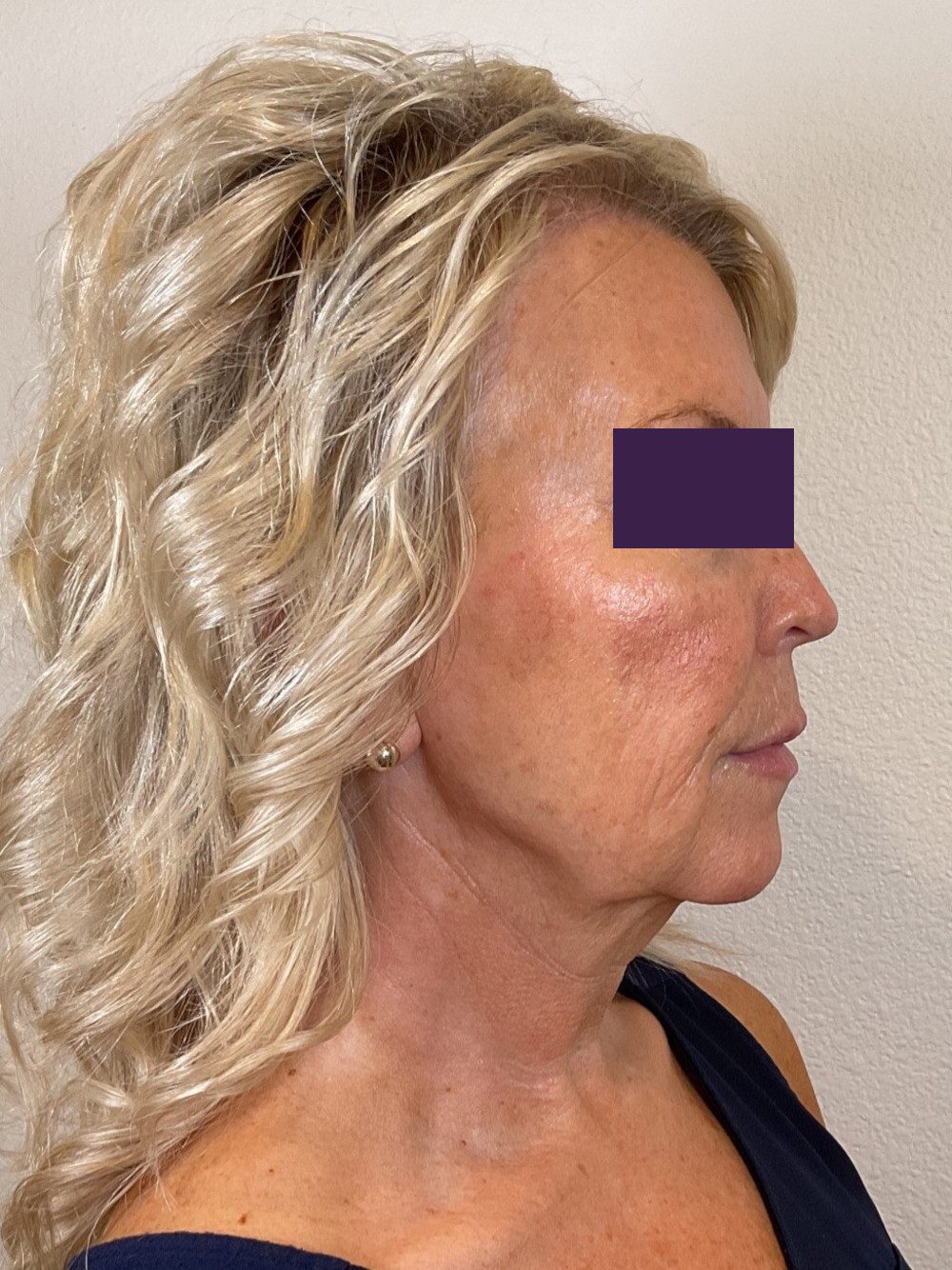 Facial Fillers Patient Photo - Case 4105 - after view-4