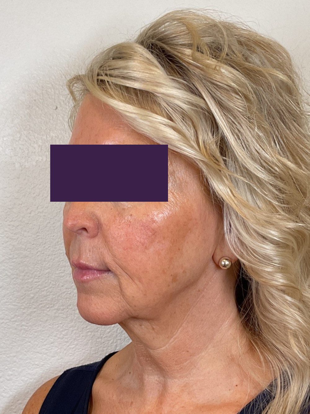 Facial Fillers Patient Photo - Case 4105 - after view-1