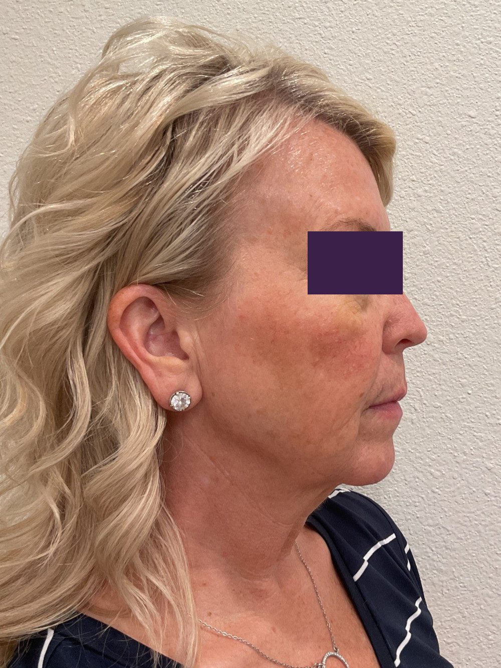 Facial Fillers Patient Photo - Case 4105 - before view-4