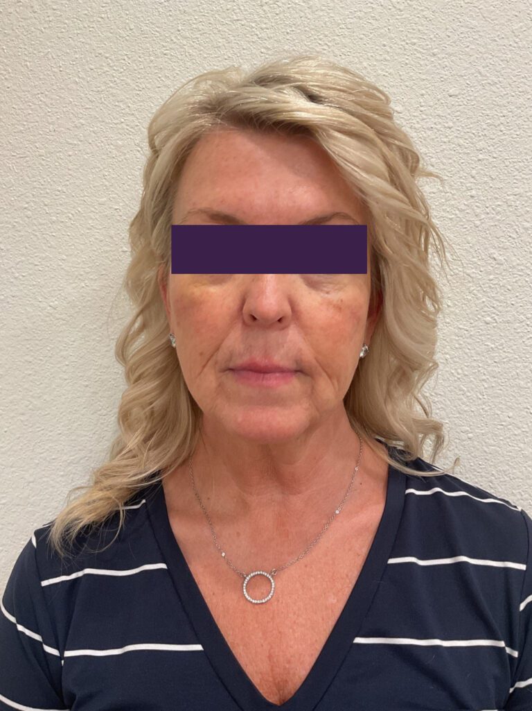 Facial Fillers - Case 4105 - Before