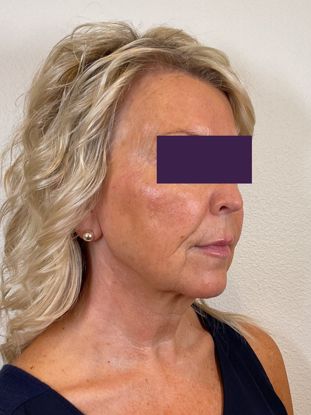 Facial Fillers Patient Photo - Case 4105 - after view-2