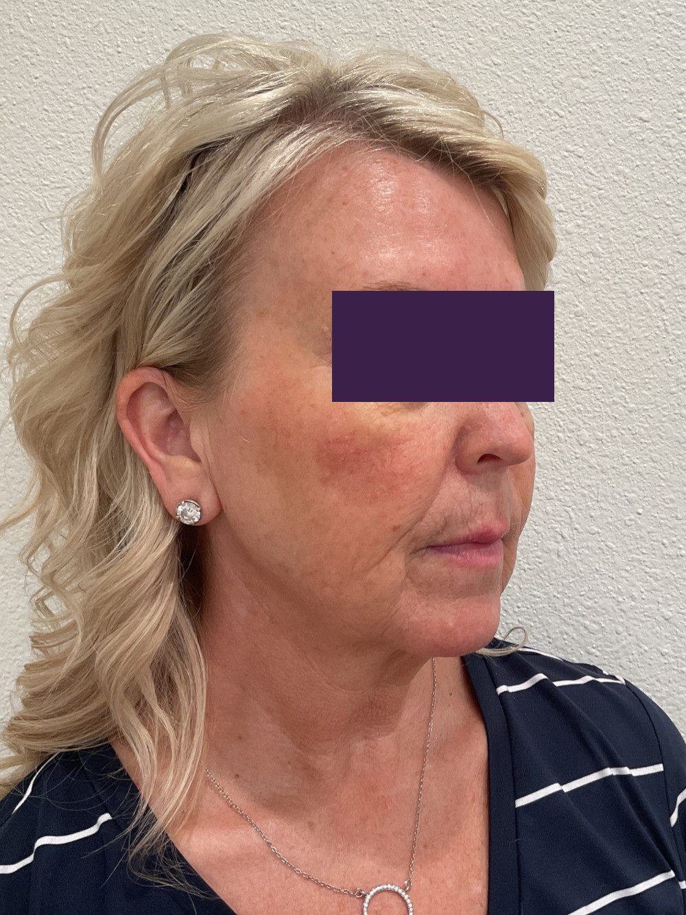 Facial Fillers Patient Photo - Case 4105 - before view-2
