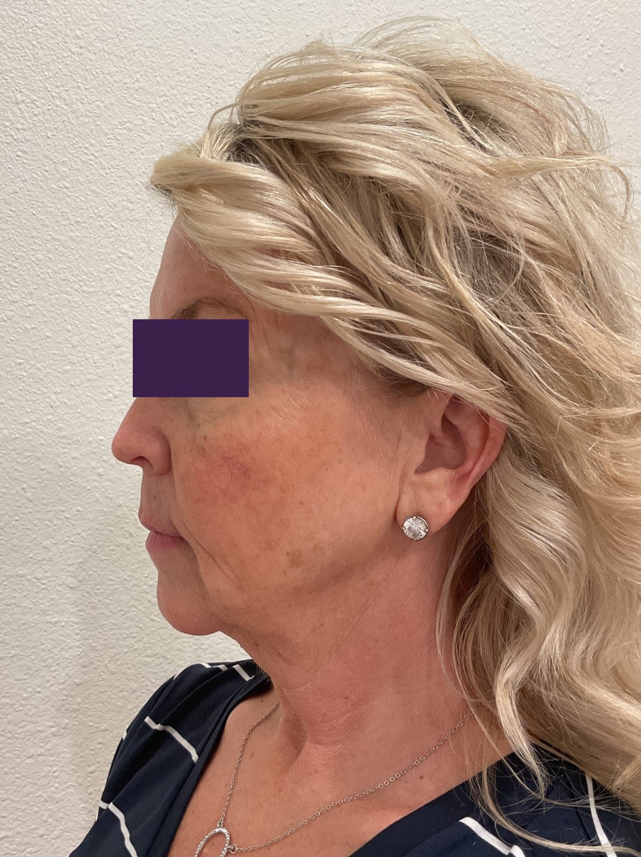 Facial Fillers Patient Photo - Case 4105 - before view-3