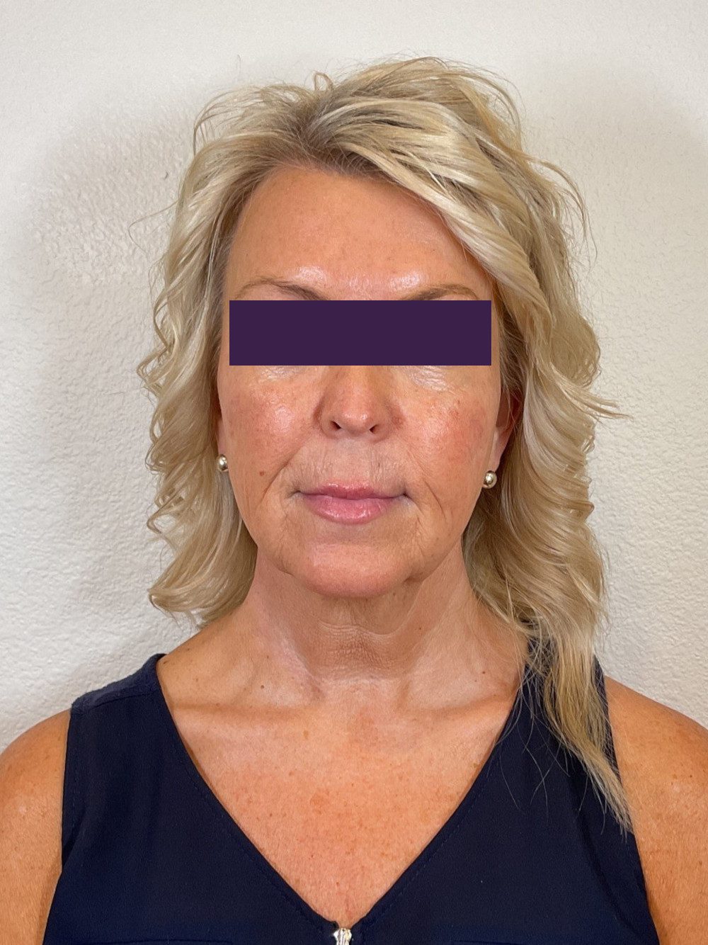 Facial Fillers Patient Photo - Case 4105 - after view-0