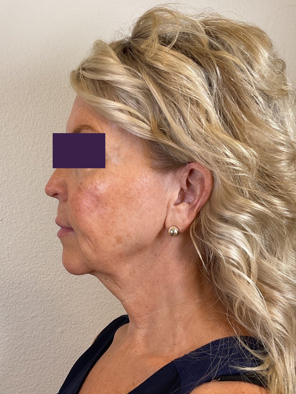 Facial Fillers Patient Photo - Case 4105 - after view-3