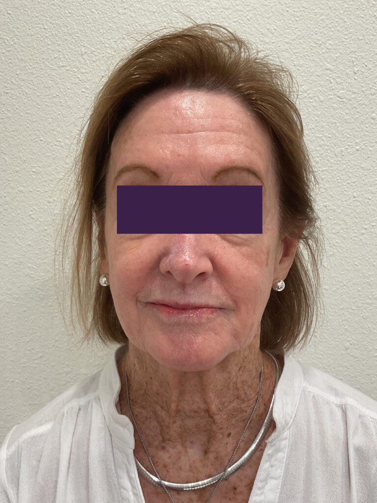 BOTOX® Cosmetic - Case 4116 - Before