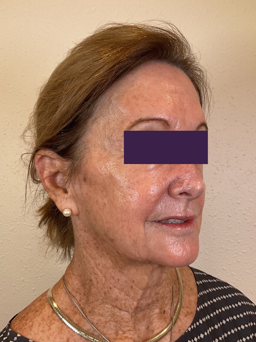 BOTOX® Cosmetic Patient Photo - Case 4116 - after view-2