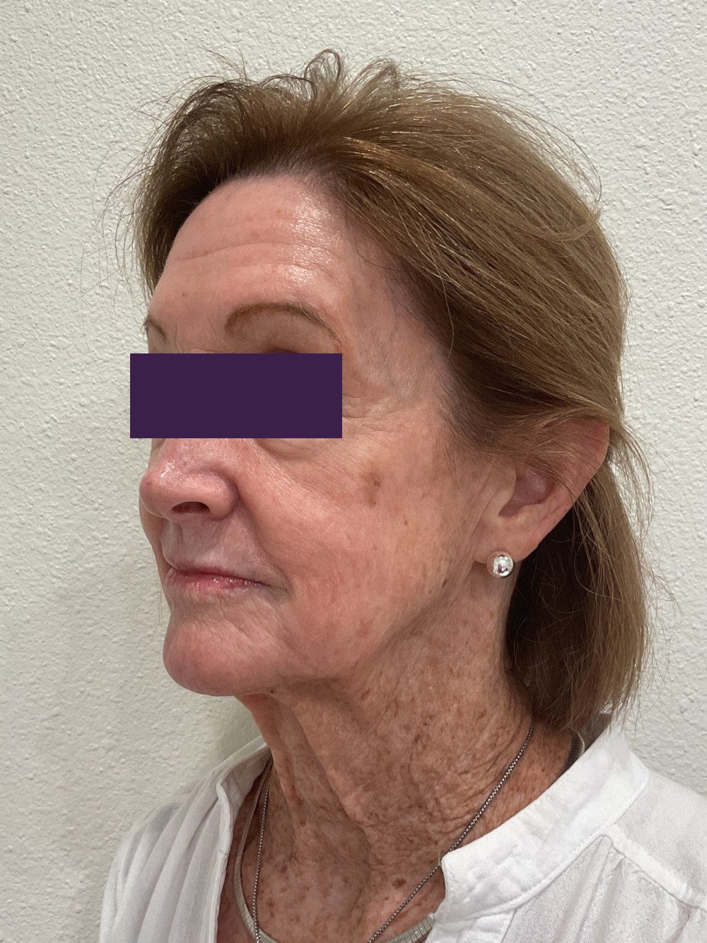 BOTOX® Cosmetic Patient Photo - Case 4116 - before view-1