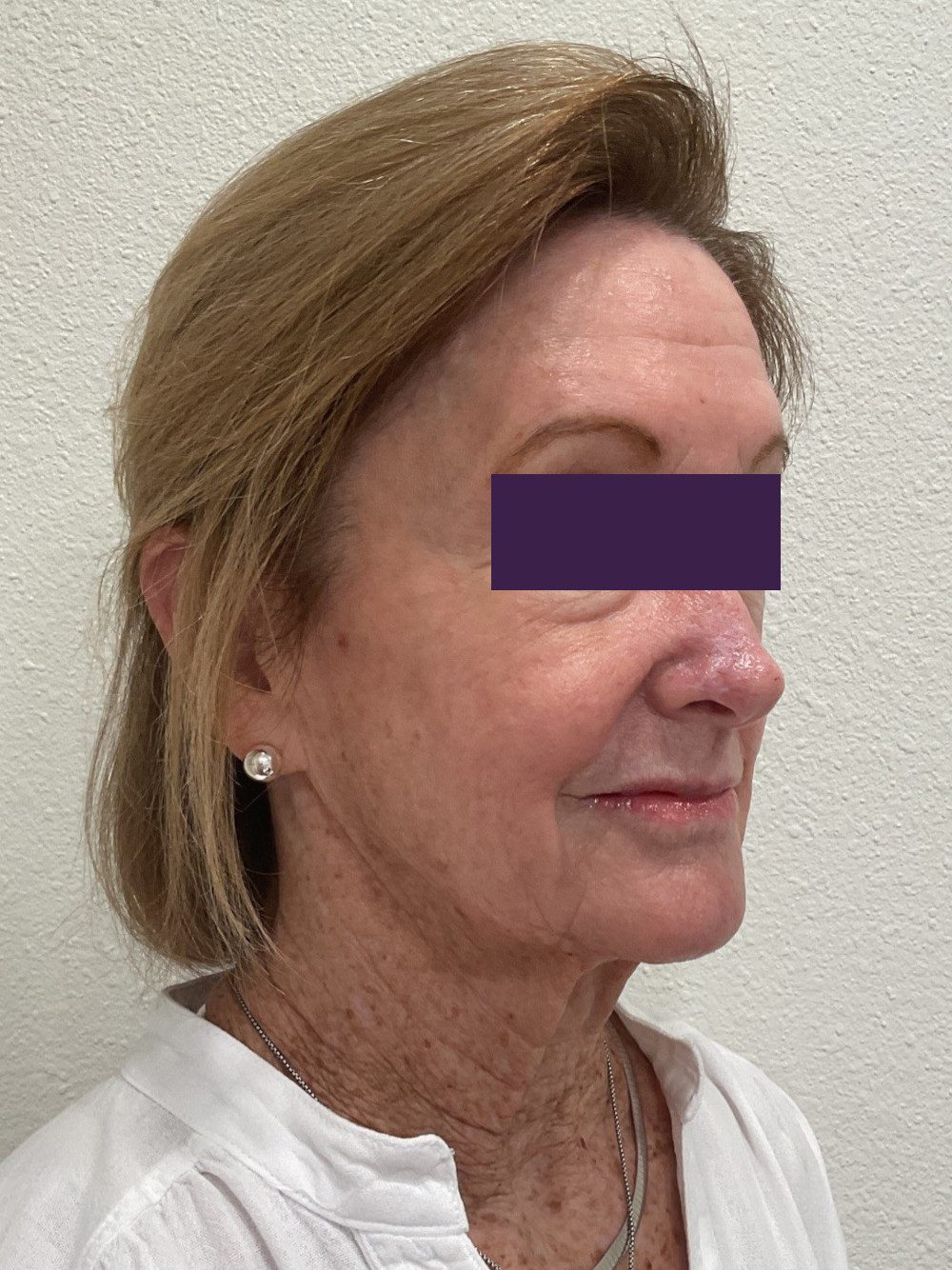 BOTOX® Cosmetic Patient Photo - Case 4116 - before view-2