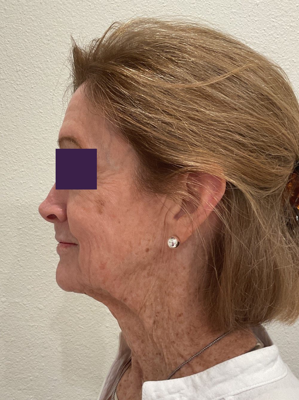 BOTOX® Cosmetic Patient Photo - Case 4116 - before view-3