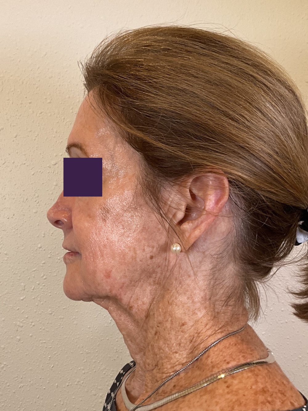 BOTOX® Cosmetic Patient Photo - Case 4116 - after view-3