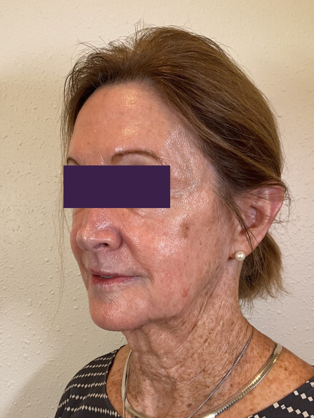 BOTOX® Cosmetic Patient Photo - Case 4116 - after view-1