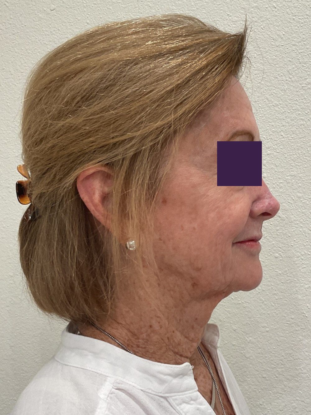 BOTOX® Cosmetic Patient Photo - Case 4116 - before view-4