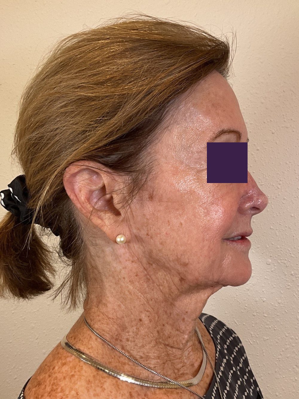BOTOX® Cosmetic Patient Photo - Case 4116 - after view-4