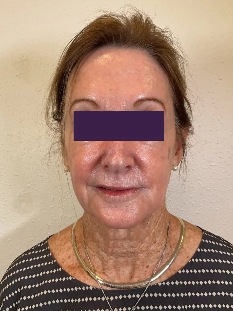 BOTOX® Cosmetic - Case 4116 - After