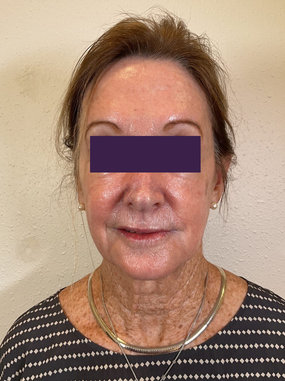 BOTOX® Cosmetic Patient Photo - Case 4116 - after view-0