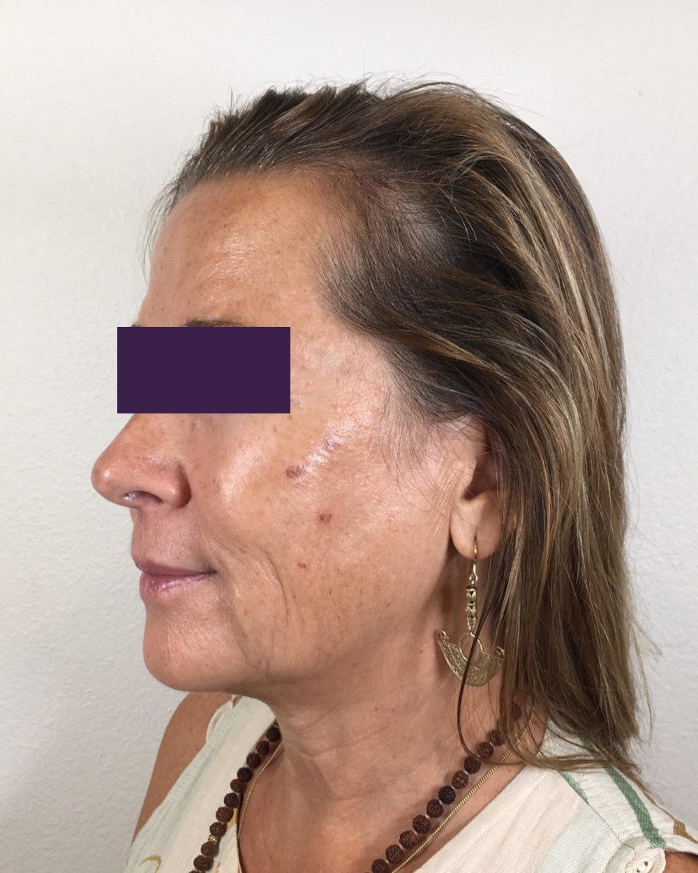 BOTOX® Cosmetic Patient Photo - Case 4174 - before view-1
