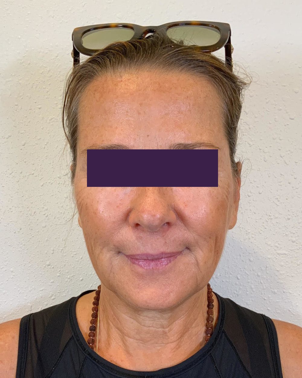 BOTOX® Cosmetic Patient Photo - Case 4174 - after view-0