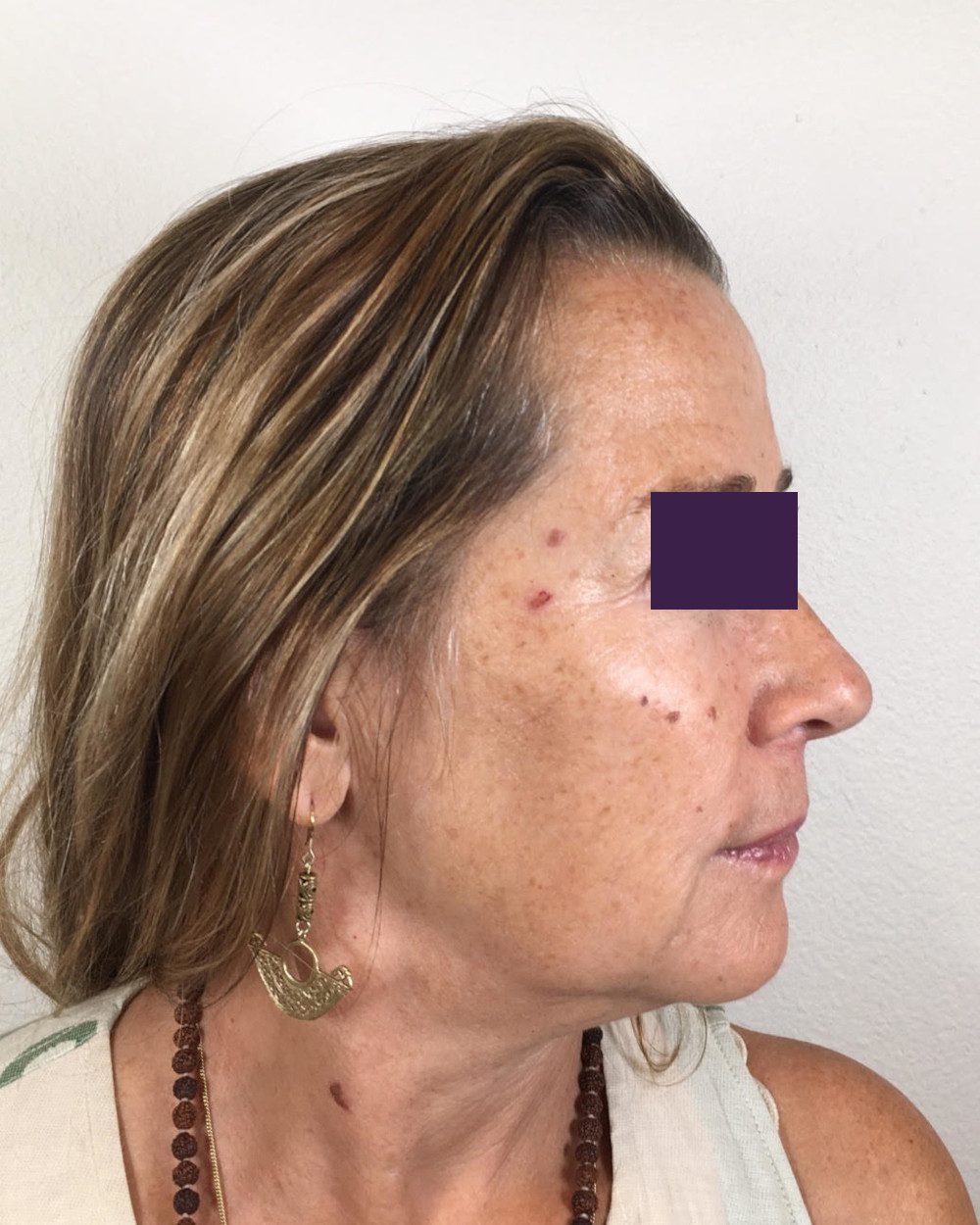 BOTOX® Cosmetic Patient Photo - Case 4174 - before view-4