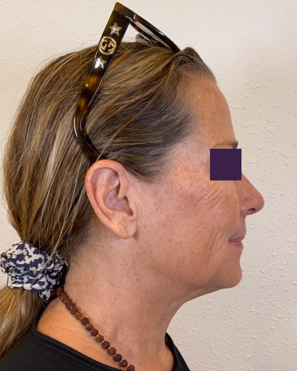BOTOX® Cosmetic Patient Photo - Case 4174 - after view-4