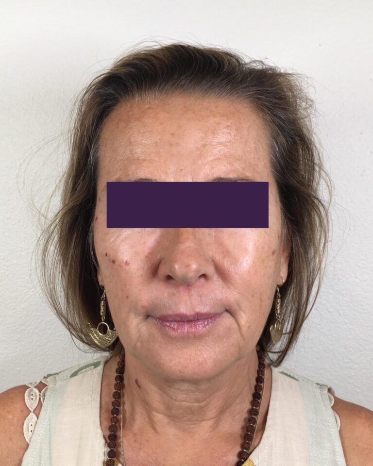 BOTOX® Cosmetic - Case 4174 - Before