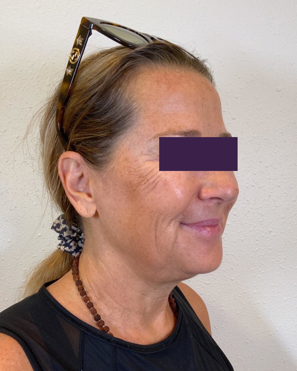 BOTOX® Cosmetic Patient Photo - Case 4174 - after view-2
