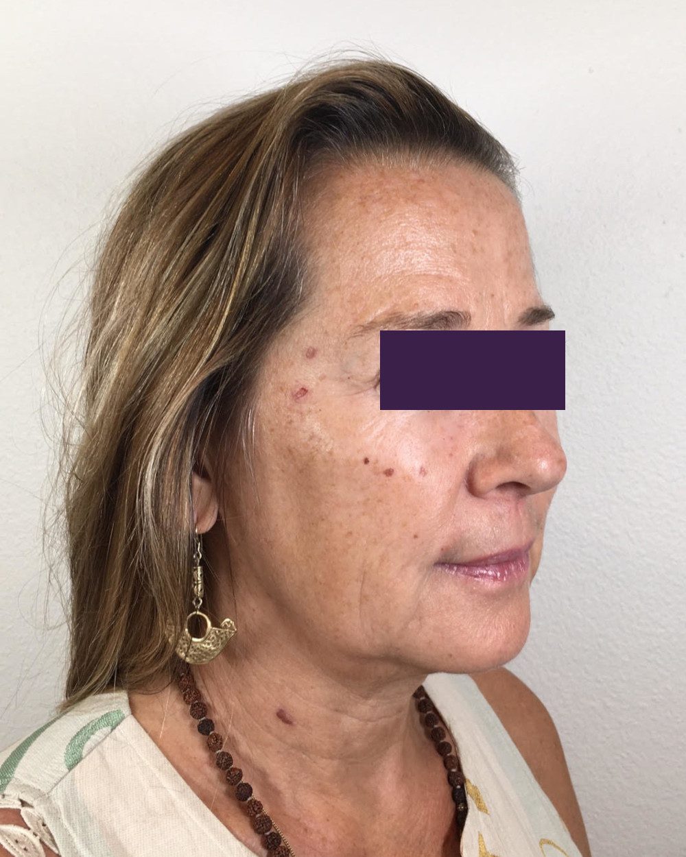 BOTOX® Cosmetic Patient Photo - Case 4174 - before view-2