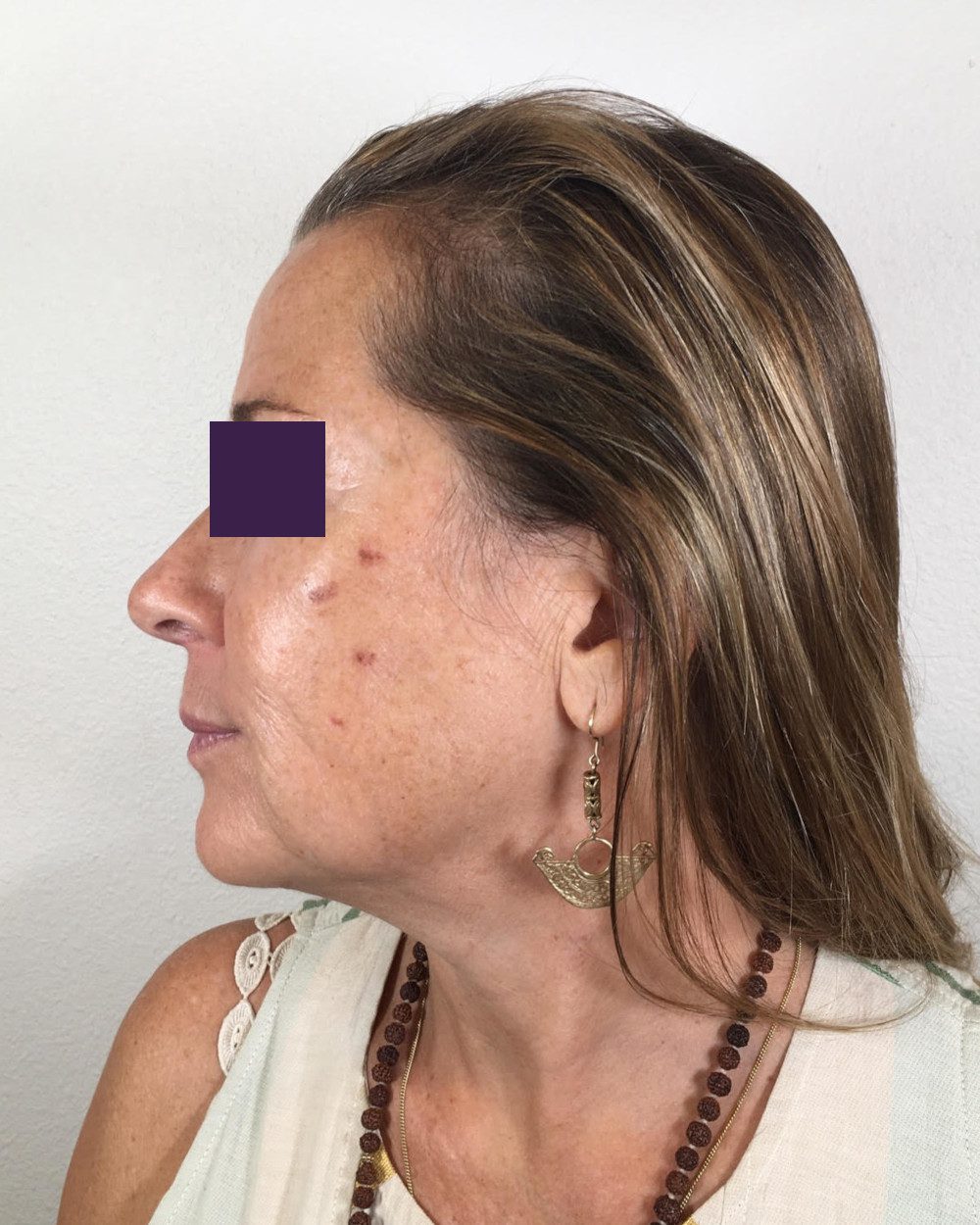 BOTOX® Cosmetic Patient Photo - Case 4174 - before view-3