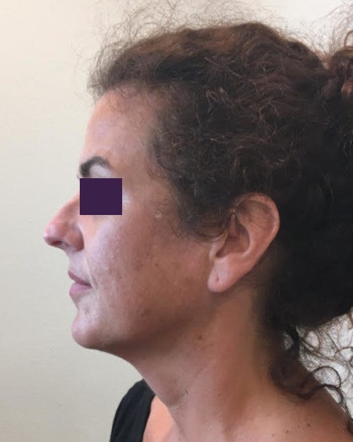 BOTOX® Cosmetic Patient Photo - Case 4189 - before view-3