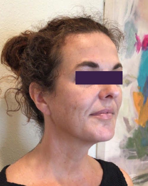 BOTOX® Cosmetic Patient Photo - Case 4189 - after view-2