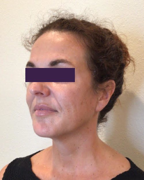 BOTOX® Cosmetic Patient Photo - Case 4189 - after view-1