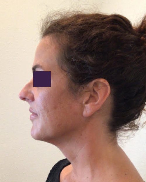 BOTOX® Cosmetic Patient Photo - Case 4189 - after view-3