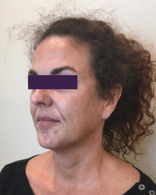 BOTOX® Cosmetic Patient Photo - Case 4189 - before view-1
