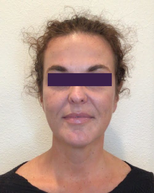 BOTOX® Cosmetic Patient Photo - Case 4189 - after view-0