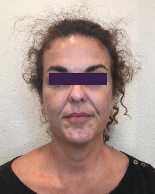 BOTOX® Cosmetic Patient Photo - Case 4189 - before view-0