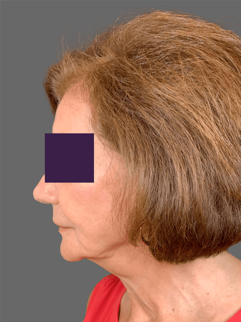 Facial Fillers Patient Photo - Case 4291 - after view-3