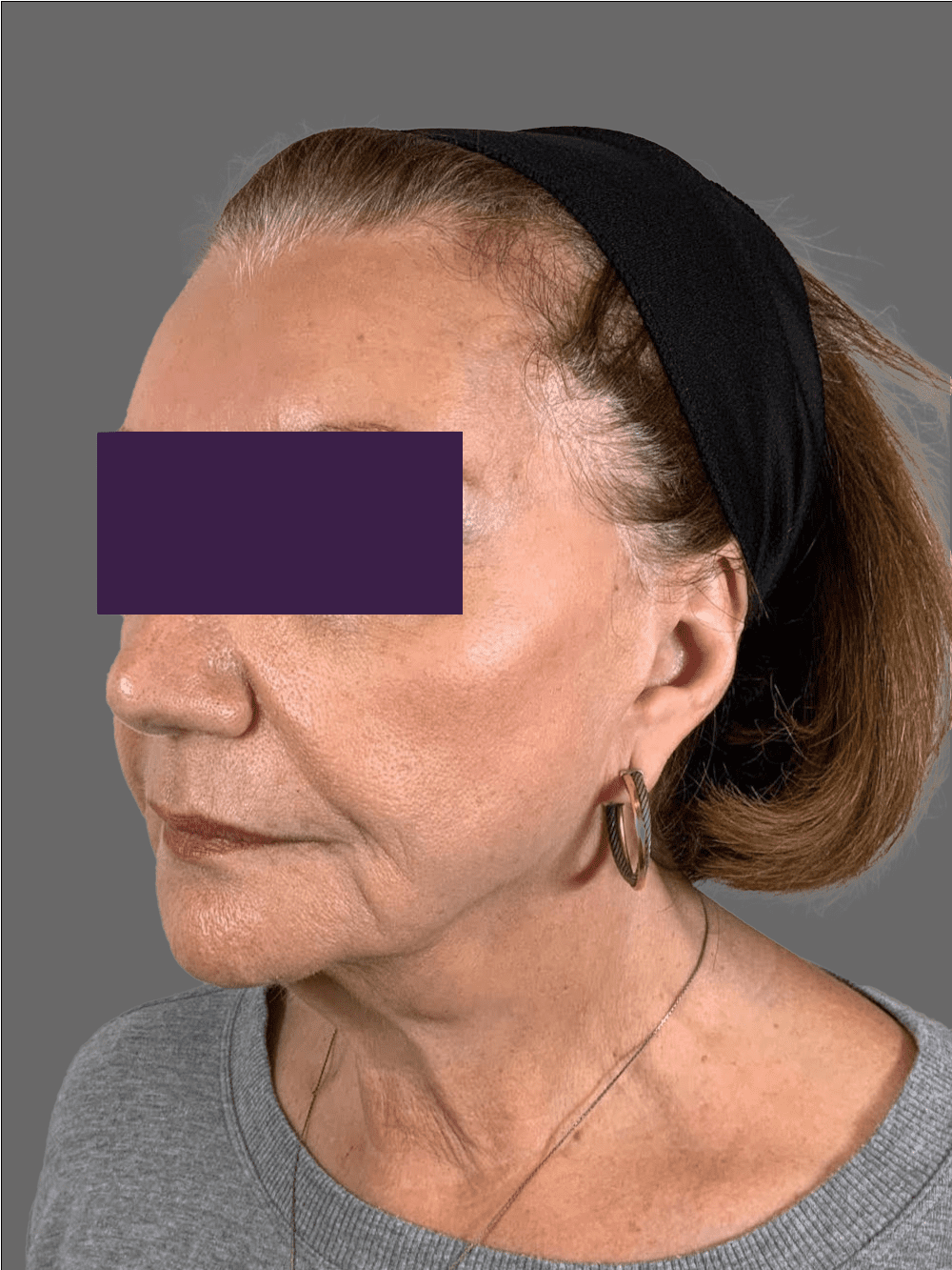 Renuva Patient Photo - Case 4291 - before view-1