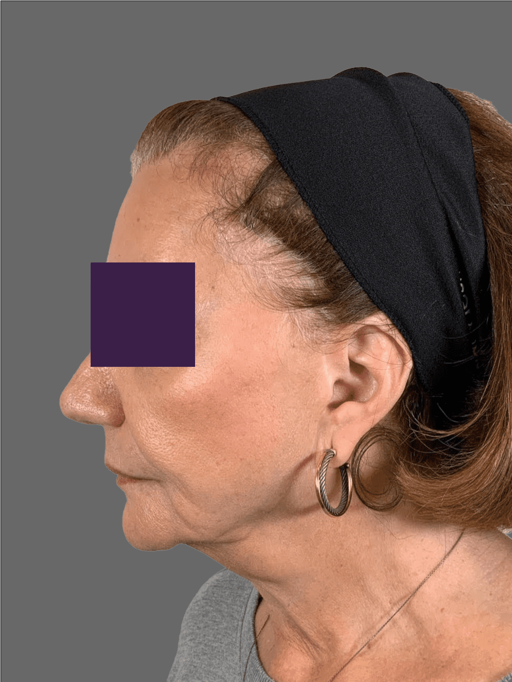 Facial Fillers Patient Photo - Case 4291 - before view-3